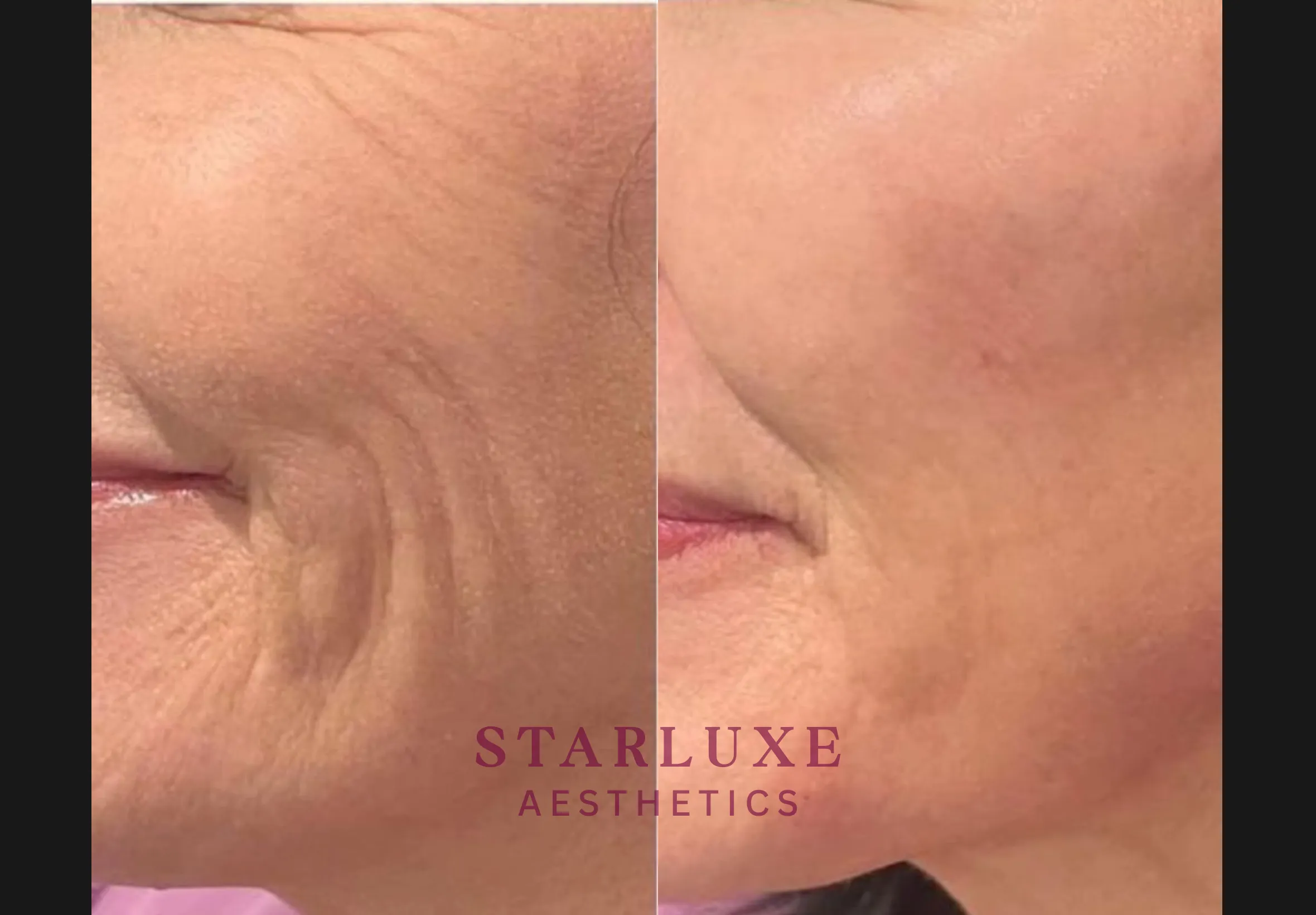 Skin transformation