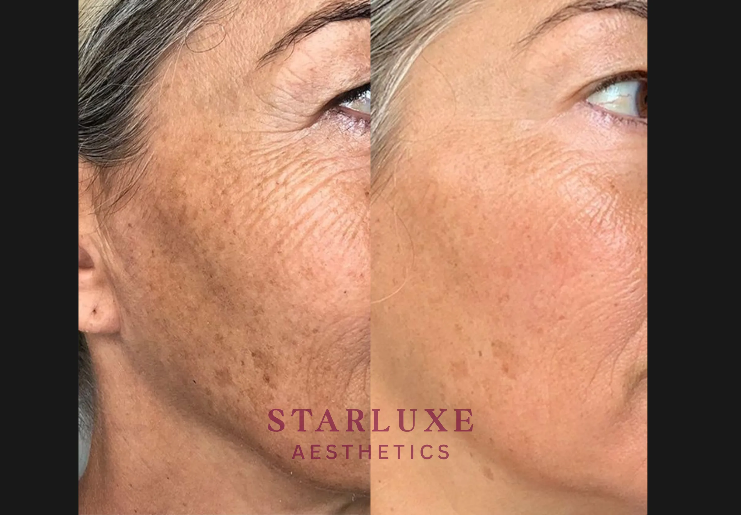 Skin transformation