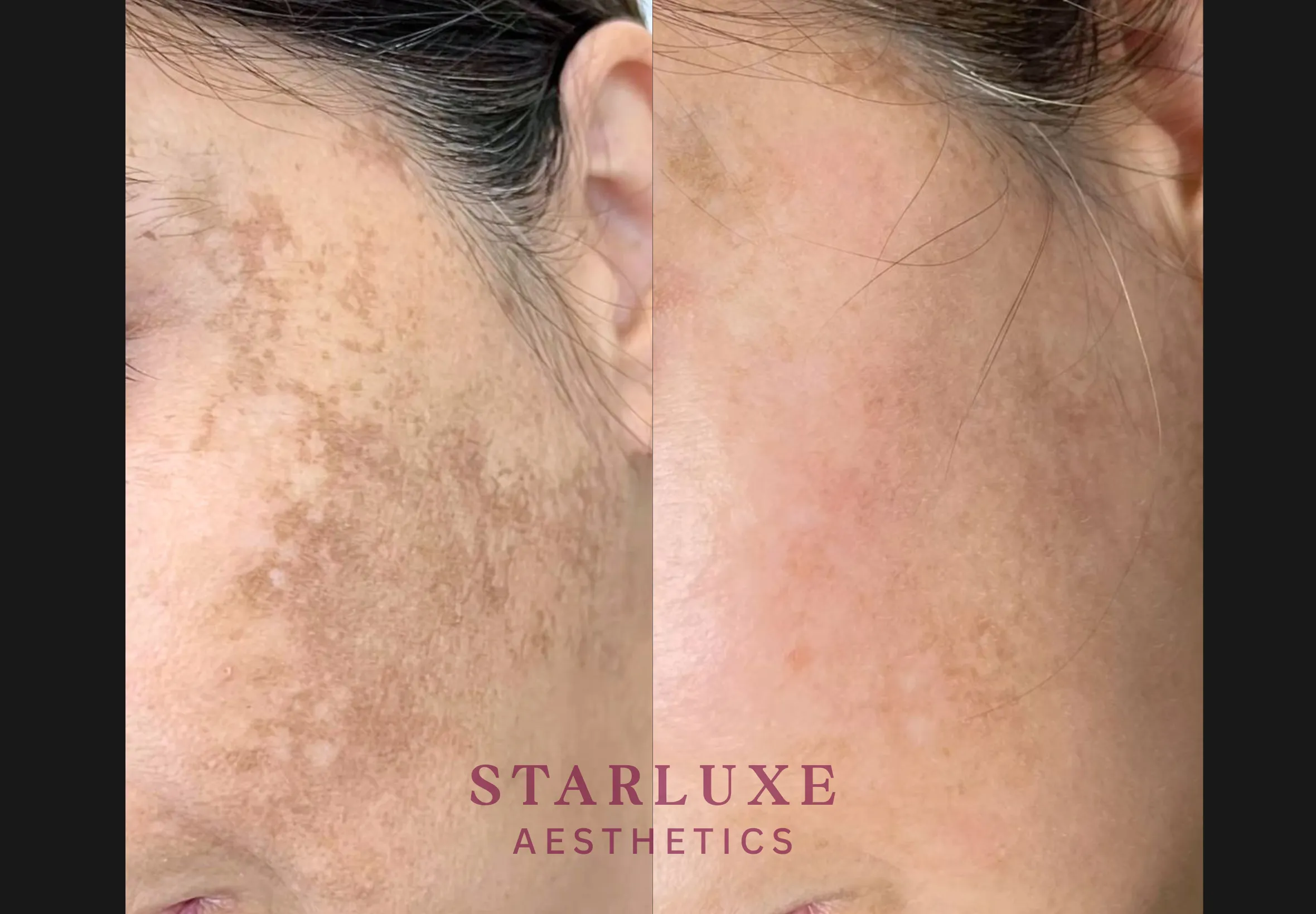 Skin transformation